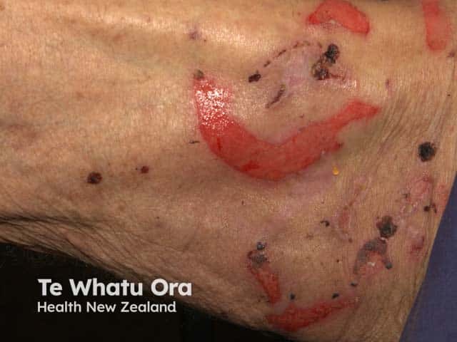 Blisters and erosions in scabies