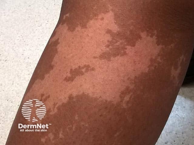 A unilateral depigmented lesion on the arm - the child was otherwise well. Now termed segmental pigmentation disorder