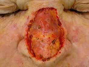 Surgical wound of skin 
