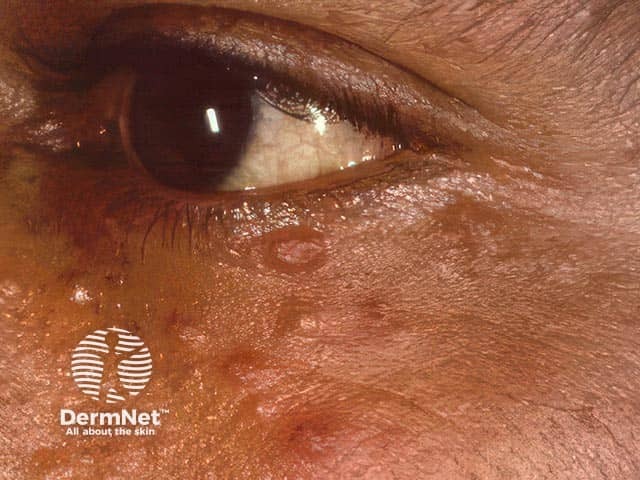 Multiple periocular trichoepitheliomas