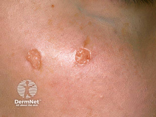 Annular trichoepitheliomata on the zygoma