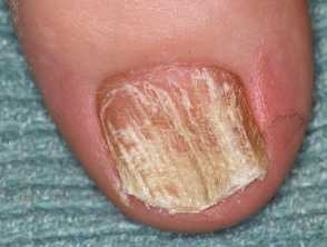 Twenty nail dystrophy