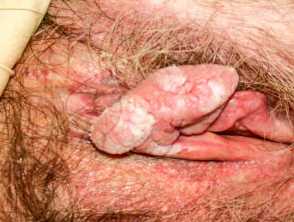 Vulval cancer