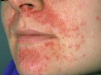 Topical corticosteroids for face eczema