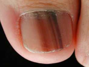 nail melanoma s