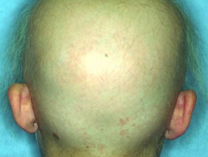 alopecia2