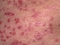 Oral steroids for psoriasis treatment