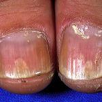 Nail psoriasis images | DermNet New Zealand