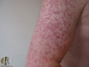 measles09